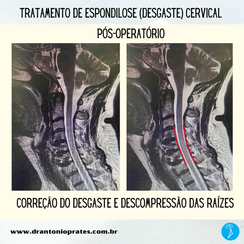 Espondilose Cervical Ou Desgaste No Pesco O Caso Cl Nico