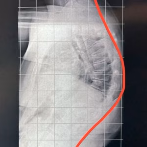 Cifose de Scheuermann