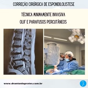 Espondilolistese OLIF