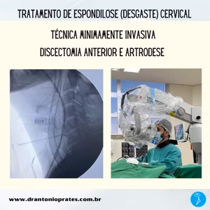 Espondilose cervical