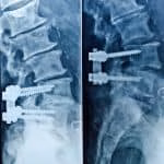 Cirurgia de hérnia de disco - especialista coluna