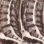 Tratamento de escoliose e deformidade