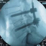 Neurocirurgião especialista em coluna BH