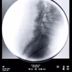 Bloqueio de dor - procedimento minimamente invasivo