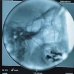 Rizotomia e radiofrequência para dor