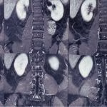 Cirurgia plexo braquial