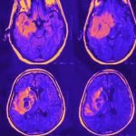 Cirurgia cerebral - neurocirurgia BH
