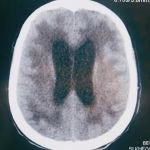 Tratamento de doenças do cérebro