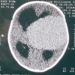 Tratamento de mielomeningocele