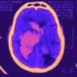 Hematoma cerebral - urgência neurocirúrgica