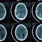 Trauma cranioencefálico - urgência neurocirúrgica