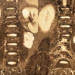 Neurofibromatose