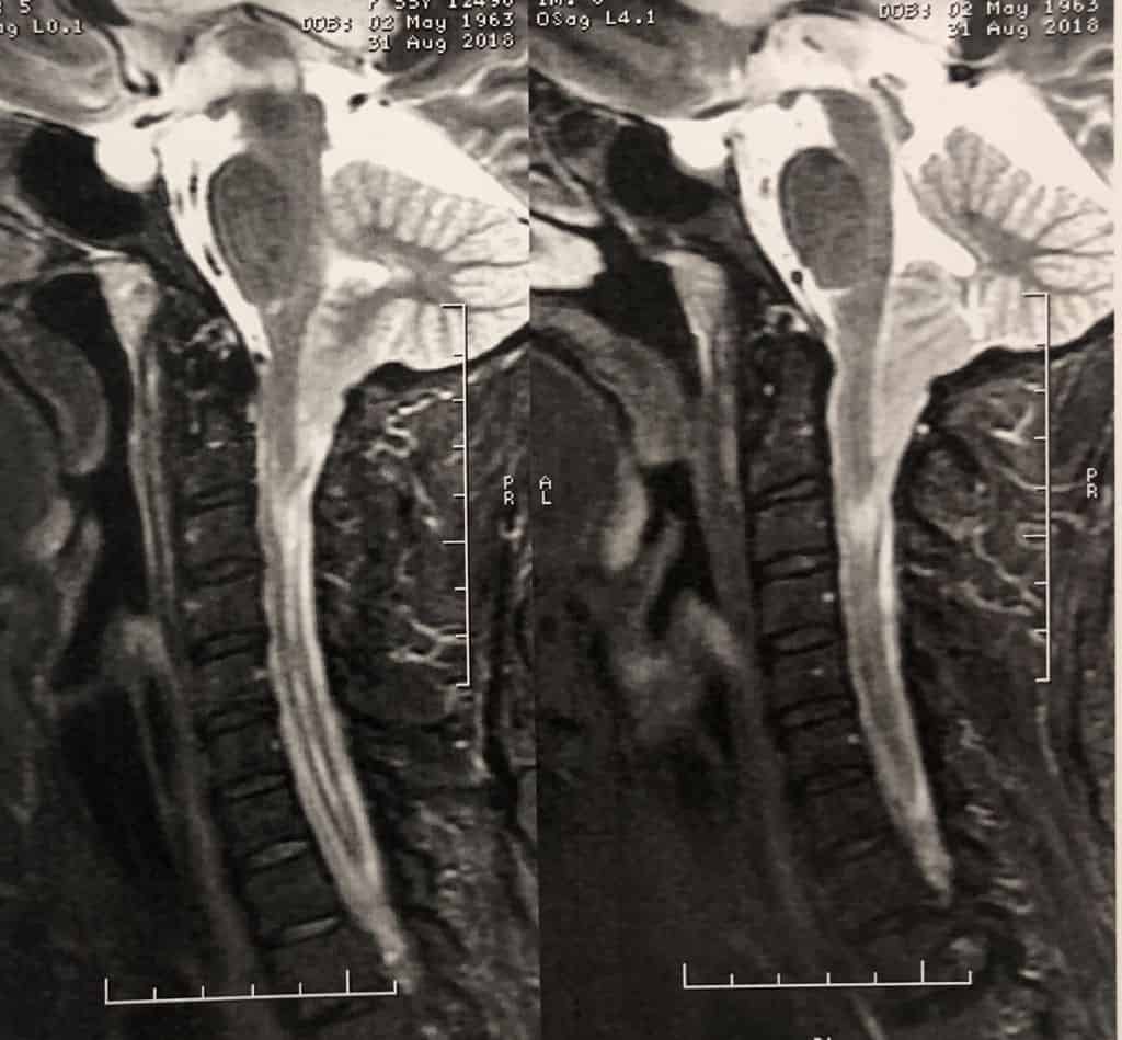 Malformação De Chiari E Siringomielia Neurocirurgião Bh 1965