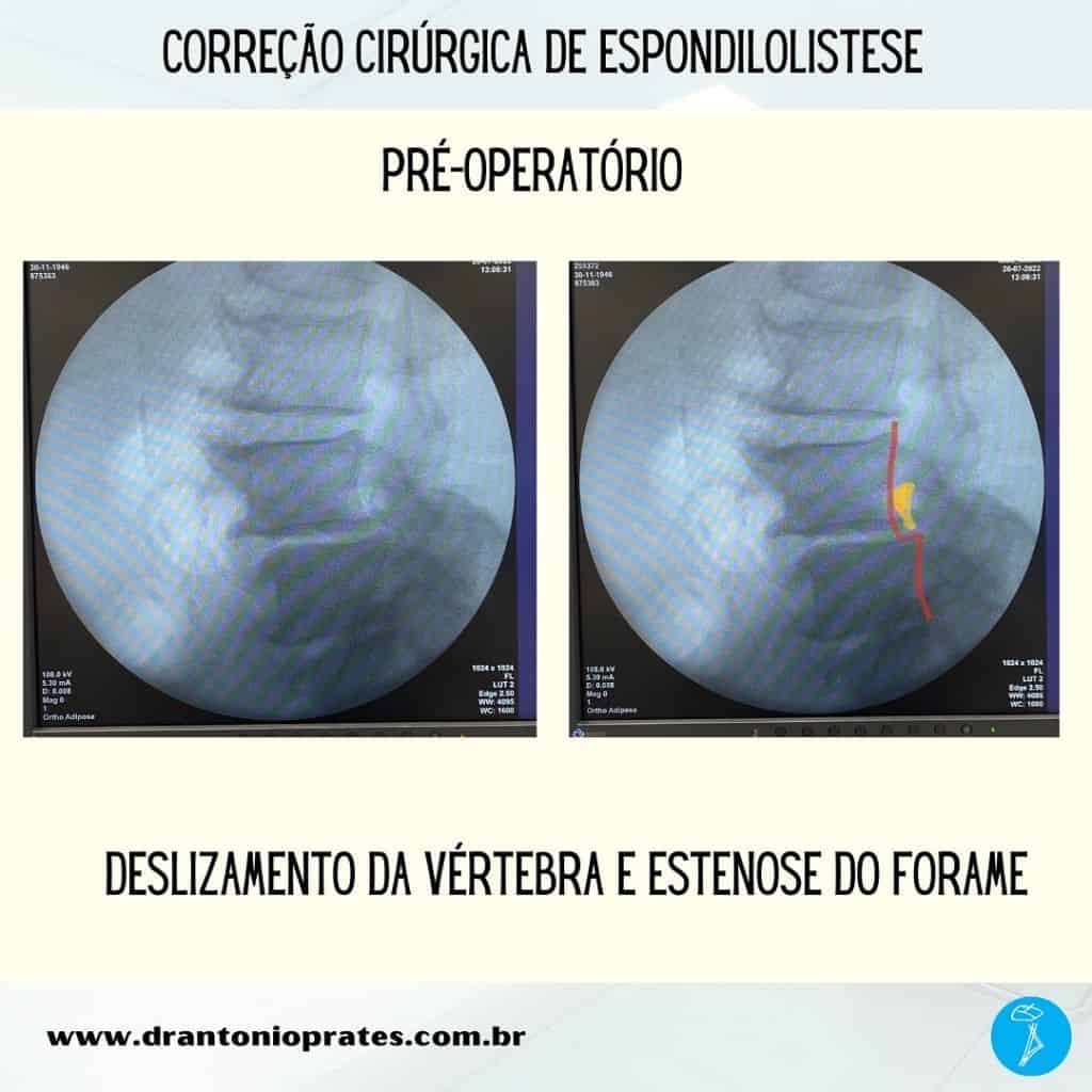 Espondilolistese Dr Ant Nio Prates Neurocirurgia E Coluna